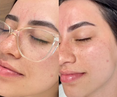 Resultado de Tratamento - Antes e Depois