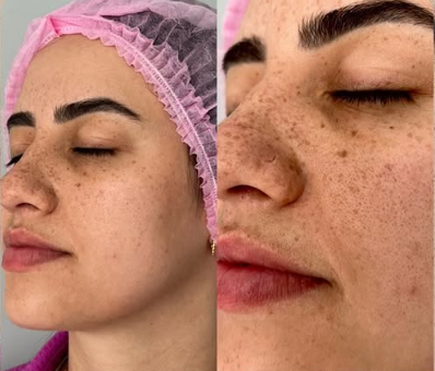 Resultado de Tratamento - Antes e Depois